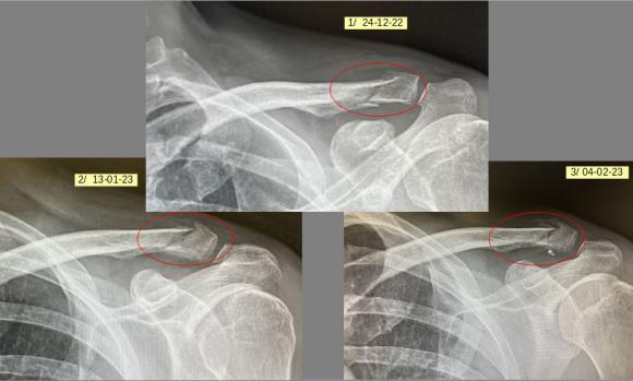 2023-02 évolution clavicule g.JPG